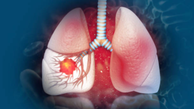 Lifestyle and lung cancer link: How daily choices raise or lower your risk