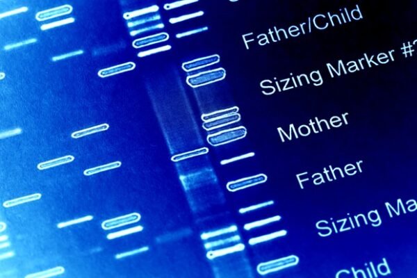 Healthy lifestyle lowers risk of diverticulitis despite genetic susceptibility